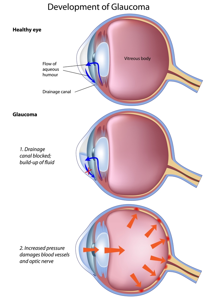 Glaucoma Treatment Cambridge MD