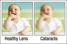 What is Cataract