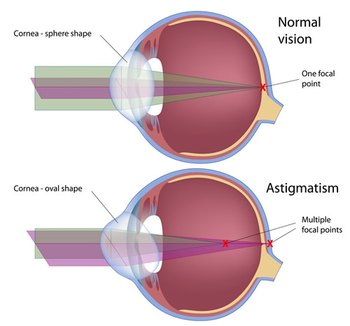 Cornea Astigmatism | Midshore Surgical Eye Center