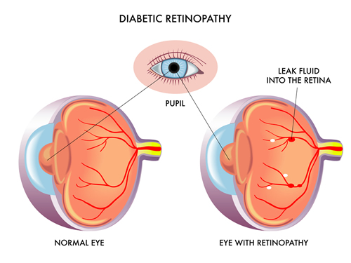 Diabetic Eye Care